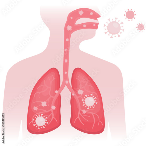 Foto Flat vector illustration of infected human lungs with viral pneumonia and coronavirus on white background