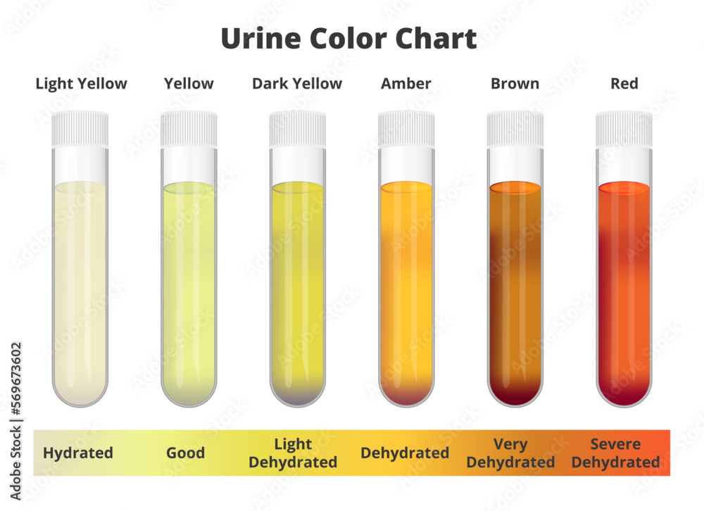 Urine color chart. Vector test tubes with different colors of urine or pee  depicting hydrated and dehydrated samples. Light and dark yellow, amber,  brown, and red urine. Medical test analysis. Stock Vector