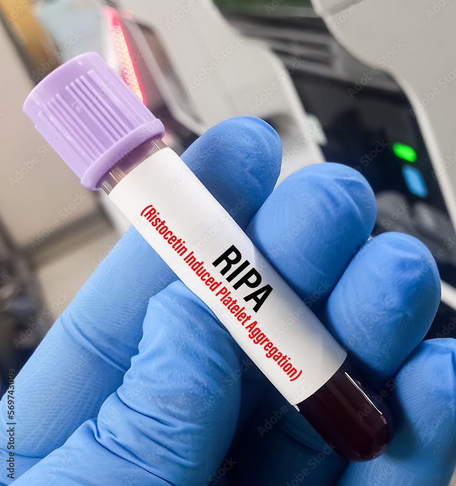 Foto de Ristocetininduced platelet aggregation (RIPA) test, to