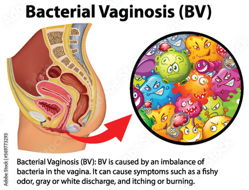 Bacterial Vaginosis (BV) infographic with explanation photo