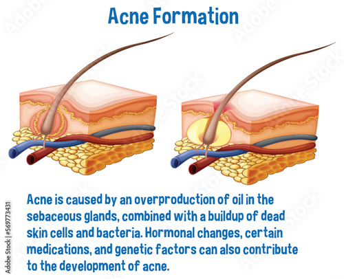 Acne formation information explanation