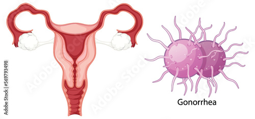Vaginal infection bacteria concept