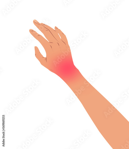 Vector illustration of hand with carpal tunnel syndrome