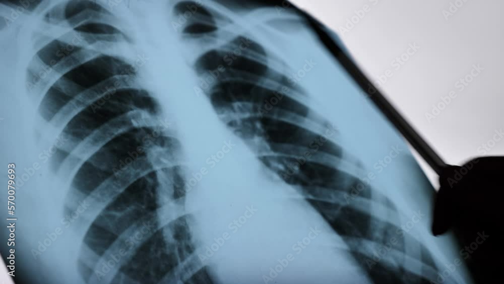 NORMAL AND PATHOLOGICAL LUNG XRAY. XRAY scan of the chest of the
