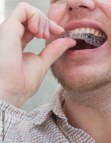 A person puts a plastic aligner plate on his teeth from brcusism, a cap for aligning his teeth. or aligner. The concept of healthy teeth in people. photo