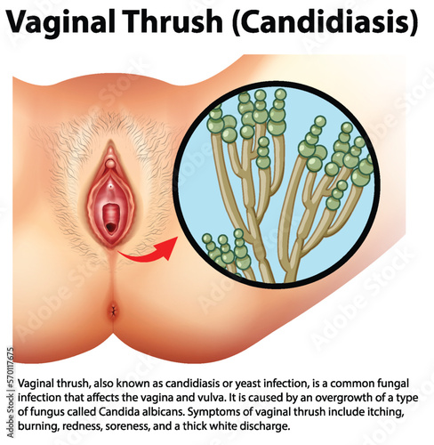 Vaginal Thrush (Candidiasis) infographic with explanation