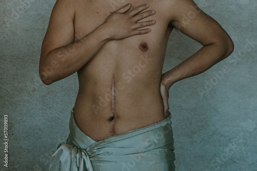 close up abdomen scar and hand on chest photo
