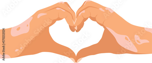 Two hands with vitiligo patches in the shape of a heart. Self love concept. World Vitiligo Day. I love my skin. Light skin with a patch of vitiligo. Skin diseases. Self care 