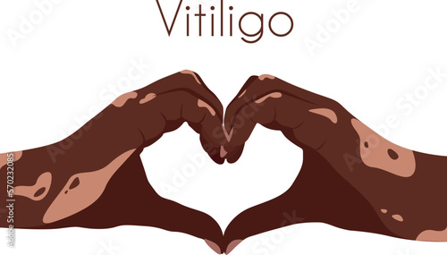 Two hands with vitiligo patches in the shape of a heart. Self love concept. World Vitiligo Day. I love my skin. Brown skin with a patch of vitiligo. Skin diseases. Self care 