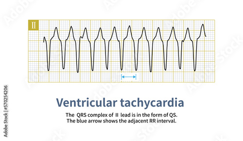 Tableau sur toile The QRS wave of ventricular tachycardia can be either a wide QRS wave or a narrow QRS wave, which depends on the origin site and activation sequence of ventricular tachycardia in the ventricle
