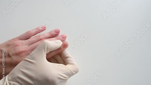 The doctor examines the affected nails - onycholysis close-up. Separation of the nail plate from the nail bed after manicure. Healthy lifestyle concept, podology photo