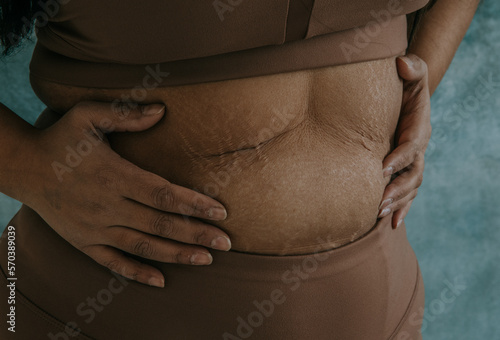 closeup of East Indian woman's hands on belly with stretchmarks