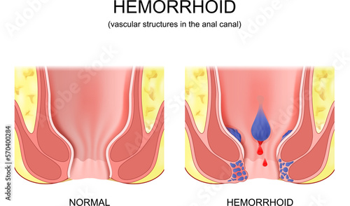 piles. comparison and difference between healthy colon and hemorrhoidal disease.