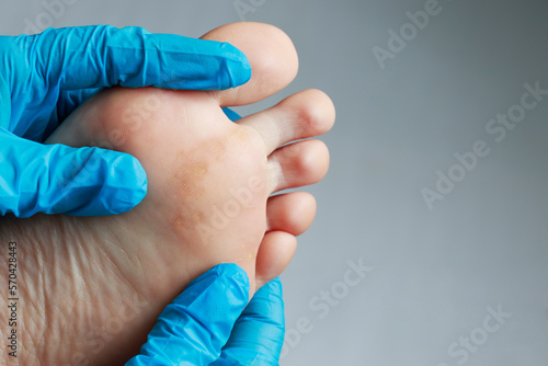 Doctor's hands in medical gloves examine the patient's legs with corns and calluses on the foot