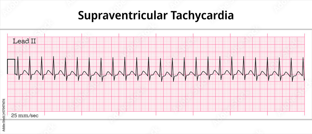 ECG Supraventricular Tachycardia - 8 Second ECG Paper ...