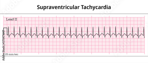 ECG Supraventricular Tachycardia - 8 Second ECG Paper - Electrocardiography Vector Medical Illustration