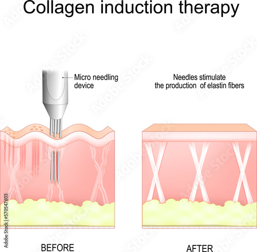 Collagen induction therapy photo