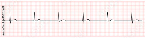 EKG Monitor Showing junctional escape rhythm  photo