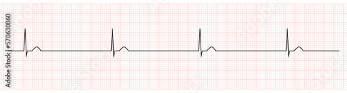 EKG Monitor Showing  junctional bradycardia