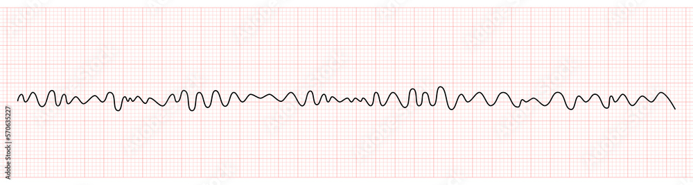EKG Monitor Showing Ventricular Fibrillation or VF
