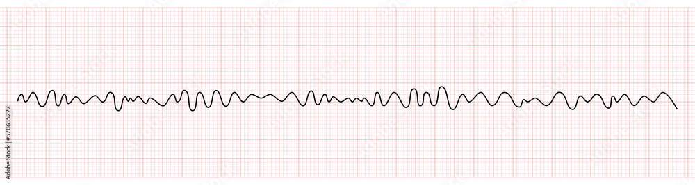 EKG Monitor Showing Ventricular Fibrillation or VF EKG Monitor Showing Ventricular Fibrillation or VF