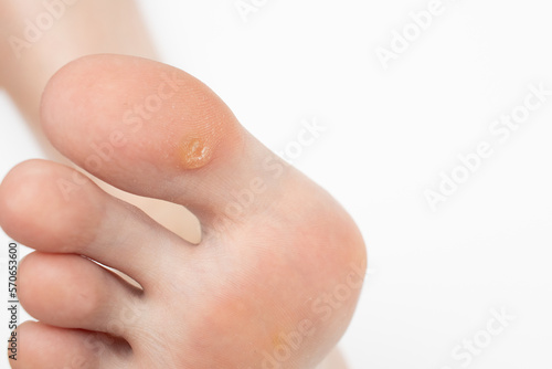 Wart on the big toe. Plantar wart on foot. Foot with corns, calluses, verrucas. photo