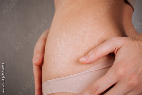Woman touching her stretch marks.
