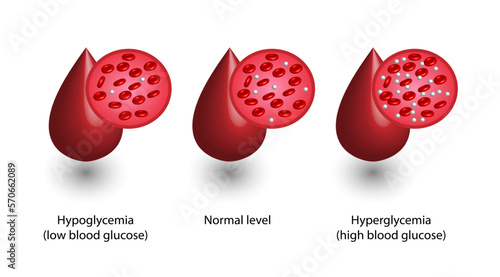 Blood Glucose Levels. Normal level, hypoglycemia (low blood sugar), hyperglycemia (high blood sugar), sugar test. Blood droplet. vector diagram illustration. photo