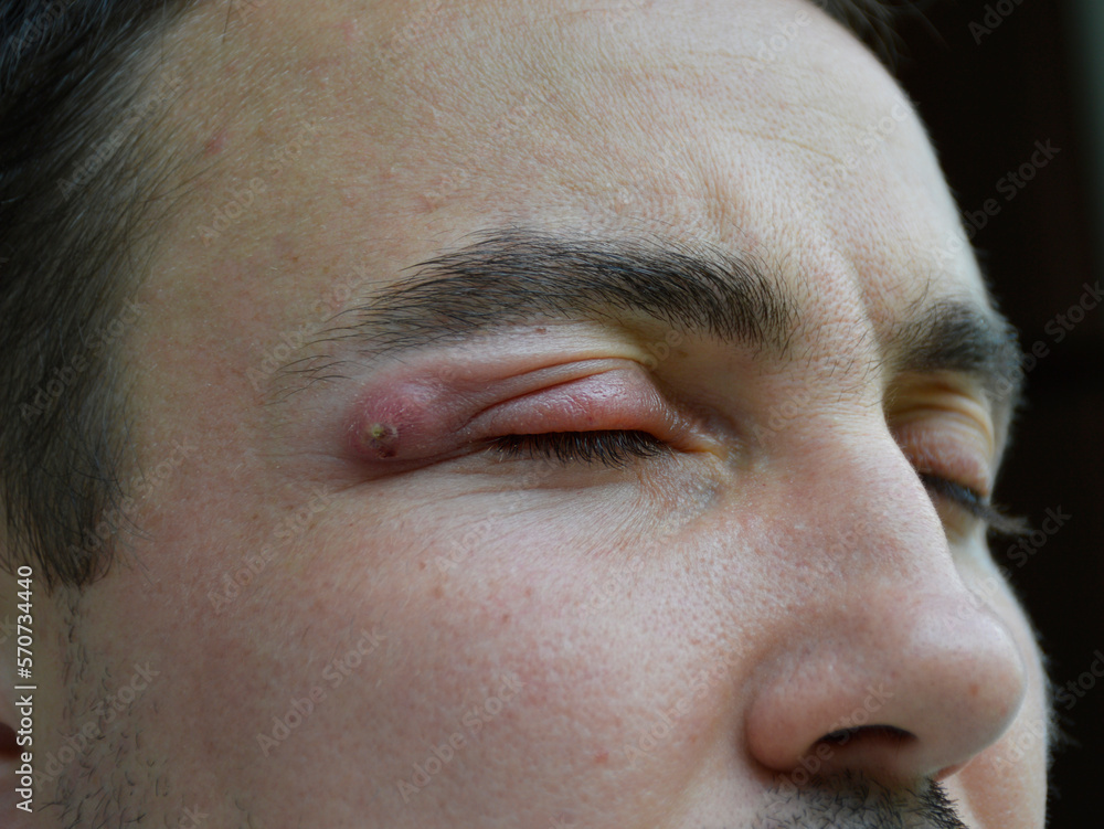 Foto de boil a strong purulent abscess in a man near the eye