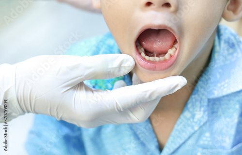 doctor screening and diagnosis mouth of tongue-tie patient , dental health problem, children show tongue and teeth