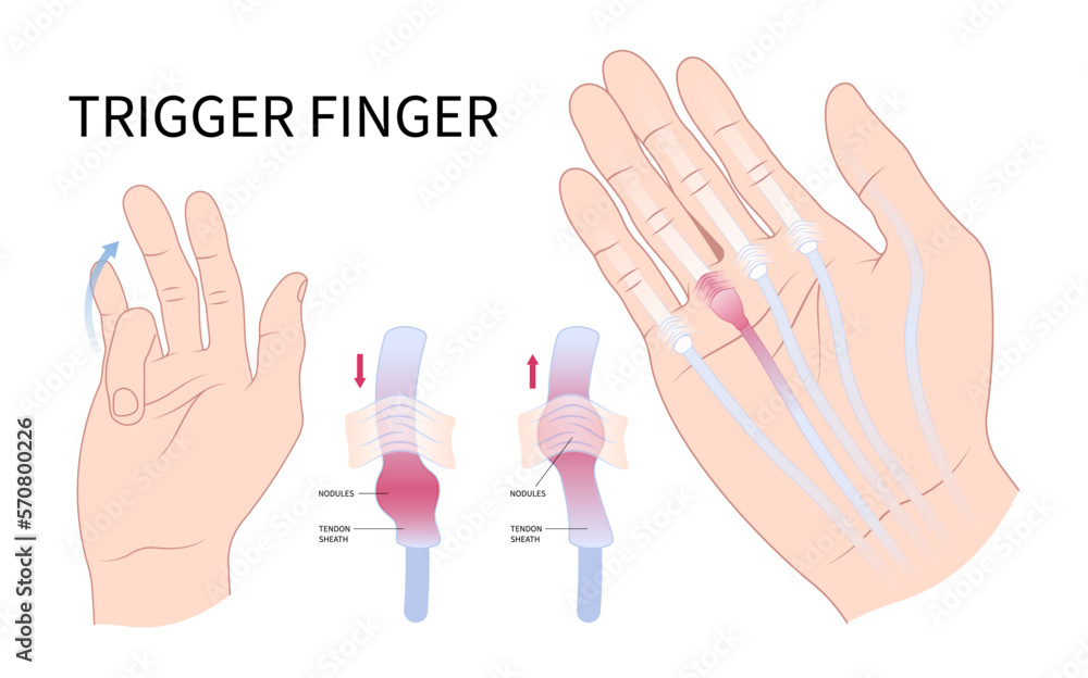 hand-cyst-flexor-pain-anatomy-medical-and-dupuytren-s-gout-diabetes