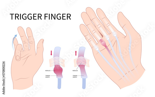 hand cyst flexor pain anatomy medical and Dupuytren's gout diabetes index lock tendon wrist bump nodule middle ring bump bend get stuck sheath inflamed swollen palm lump muscle examine join bone