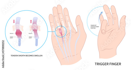 palm lump muscle examine hand cyst flexor pain anatomy medical and Dupuytren's gout diabetes index lock tendon wrist bump nodule middle ring bump bend get stuck sheath inflamed swollen join bone