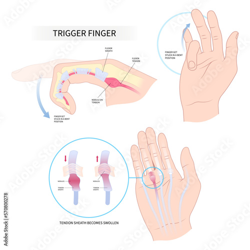 diabetes palm hand cyst flexor pain anatomy medical and Dupuytren's gout index lock tendon wrist bump nodule middle ring bump bend get stuck sheath inflamed swollen lump muscle examine join bone