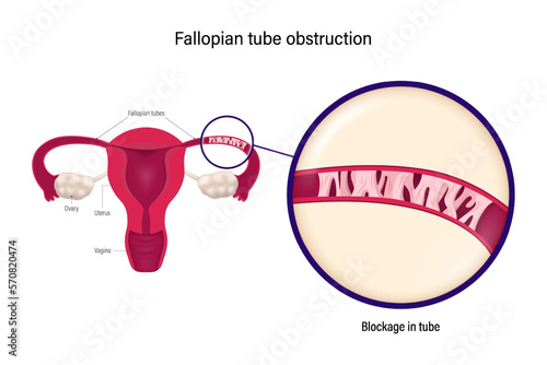 Fallopian tube obstruction. Block fallopian tube. occlusion is a major cause of female infertility. photo