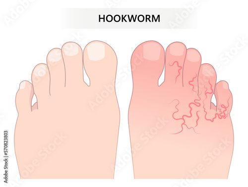 Skin rash pain feet parasitic worm intestinal small large bowel colon gut stool poor larvae poop eye larva soil Weight loss dirt