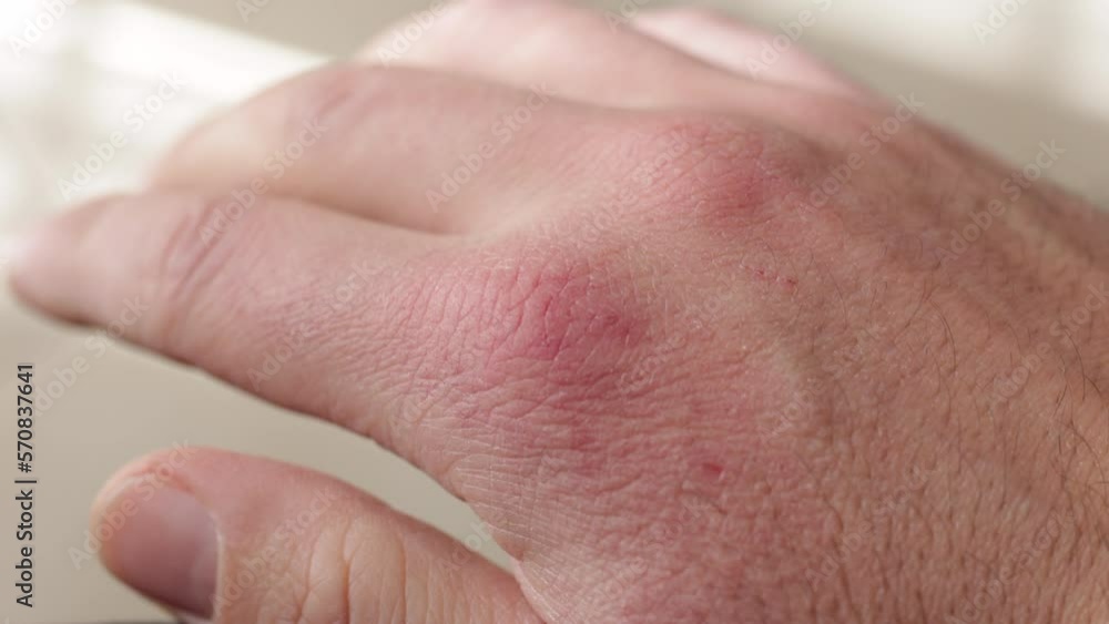 Close up of dry and cracked skin on a young male hand. Dermatology concept. Slow motion Close up of dry and cracked skin on a young male hand. Dermatology concept. Slow motion