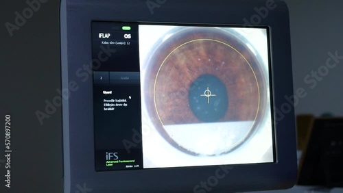 Laser operation in laser eye surgery, close eye shot from monitor stock video. Whole process of eye lasering and scanning on monitor. photo