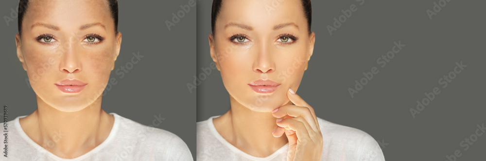 Fototapeta premium Dark spots, freckles,hyperpigmentation(melasma or chloasma),concept - skin lightening, skin whitening, fruit acids,AHA, Skin Brightening