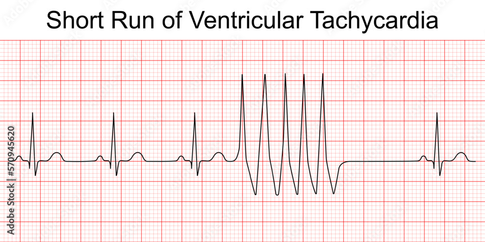 Vecteur Stock Electrocardiogram short run of ventricular tachycardia