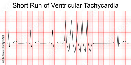 Electrocardiogram short run of ventricular tachycardia (VT). Cardiac fibrillation. Heart beat. ECG. EKG. Vital sign. Life support. Medical healthcare symbol.