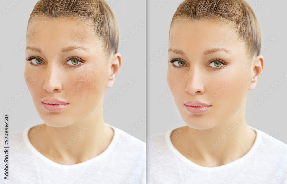 Dark spots, freckles,hyperpigmentation(melasma or chloasma),concept - skin lightening, skin whitening, fruit acids,AHA, Skin Brightening Dark spots, freckles,hyperpigmentation(melasma or chloasma),concept - skin lightening, skin whitening, fruit acids,AHA, Skin Brightening