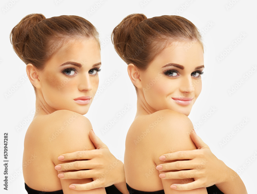 Dark spots, freckles,hyperpigmentation(melasma or chloasma),concept - skin lightening, skin whitening, fruit acids,AHA, Skin Brightening Dark spots, freckles,hyperpigmentation(melasma or chloasma),concept - skin lightening, skin whitening, fruit acids,AHA, Skin Brightening