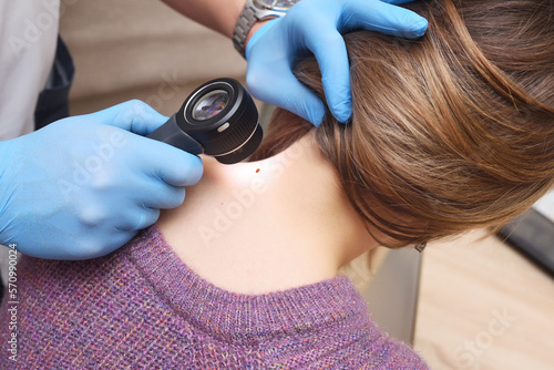 dermatologist examines a mole on the patient's neck using a special device - a dermatoscope. Prevention of skin cancer - melanoma. photo