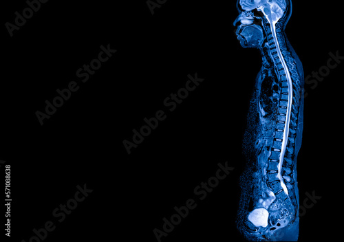 Blue tone radiograph on dark background in hospital.Doctor used MRI to diagnosis the illness of patient.MRI of human spine in sagittal or lateral view.Diagnosis of spine metastasis with back pain.