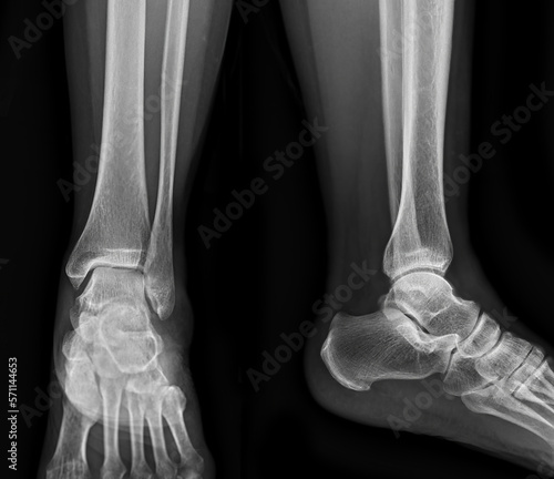 X-ray image of ankle joint .