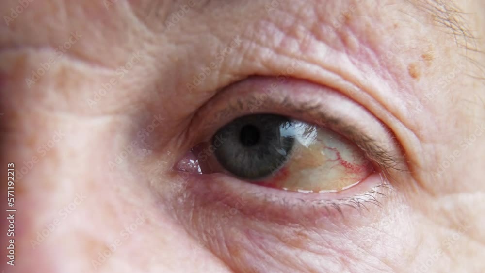 Video Stock Ophthalmology. Eye with dilated blood vessels of an old