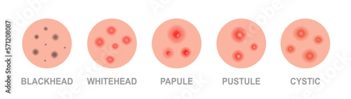Types of acne. Skincare problems and inflammation. Acne skin types - blackheads, whiteheads, papules, pustules, cystic and nodular.
