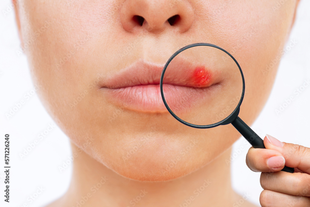 Herpes on the lip. Young woman with blisters caused by virus on the
