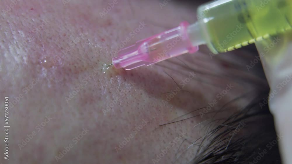 close-up-shot-of-plasma-treatment-plasmolifting-or-prp-method-point